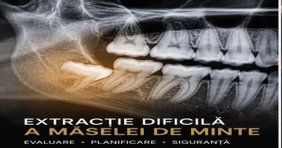 Extracție dificilă de măsea de minte în Sector 4 – molar inclus, orizontal sau aproape de nerv