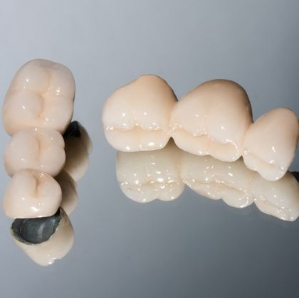 Coroană metalo-ceramică - Restaurare dentară durabilă și estetică | SparklingMoon Dental