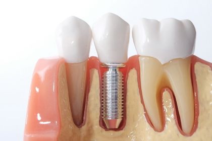 Adiție osoasă și membrane - Regenerare osoasă pentru implanturi dentare | SparklingMoon Dental