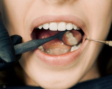 Importanța igienizării dentare regulate și curățării subgingivale